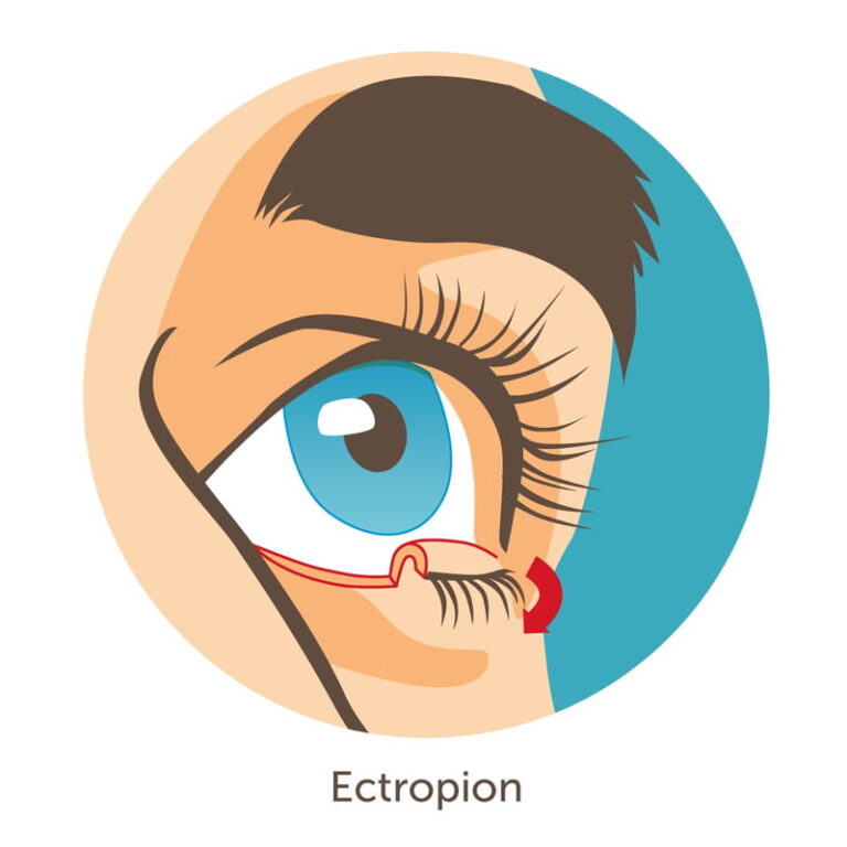 Entropion - Ectropion - Visum