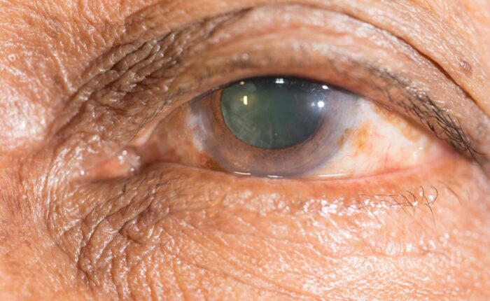 Cataratas en los Ojos Conoce las causas y tratamiento /